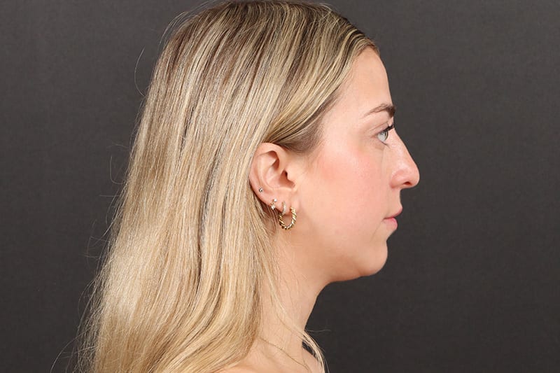 Chin Liposuction Before & After Image