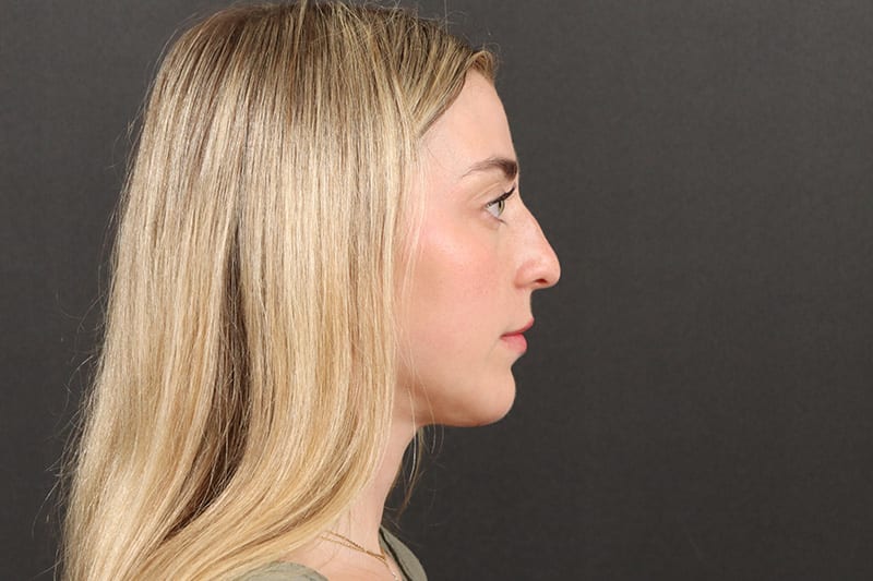 Chin Liposuction Before & After Image