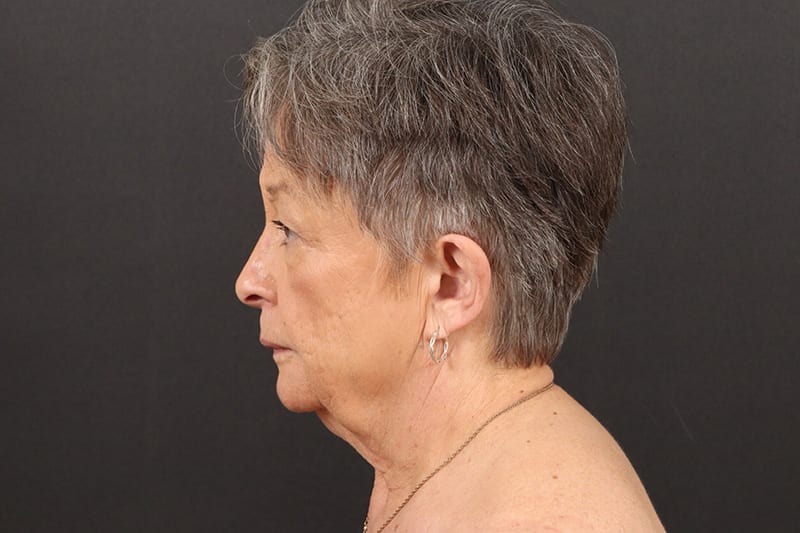 Face and Neck Lift Before & After Image