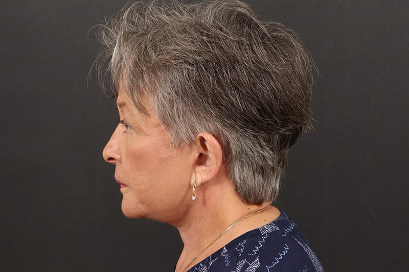 Face and Neck Lift Before & After Image