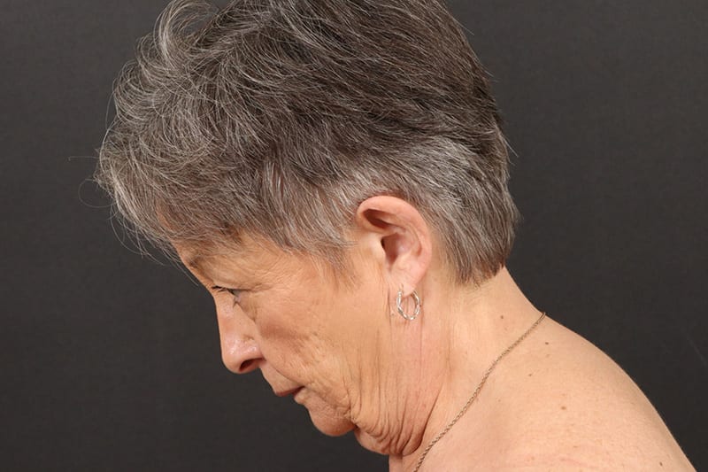 Face and Neck Lift Before & After Image