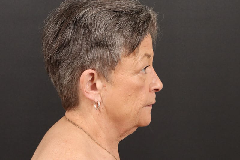 Face and Neck Lift Before & After Image