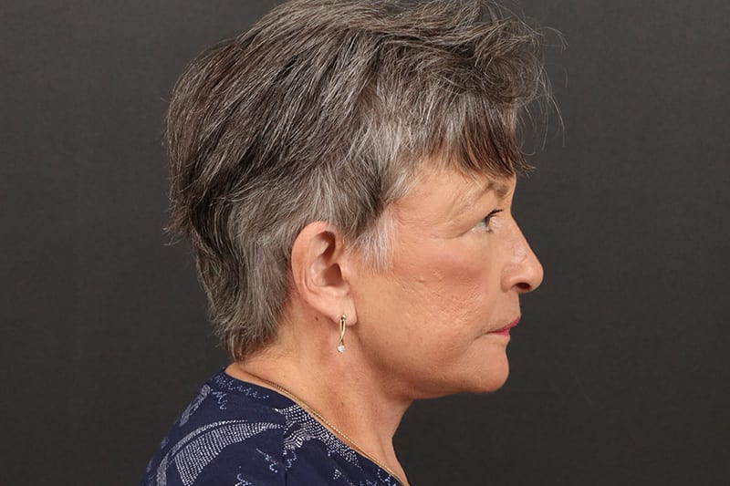 Face and Neck Lift Before & After Image