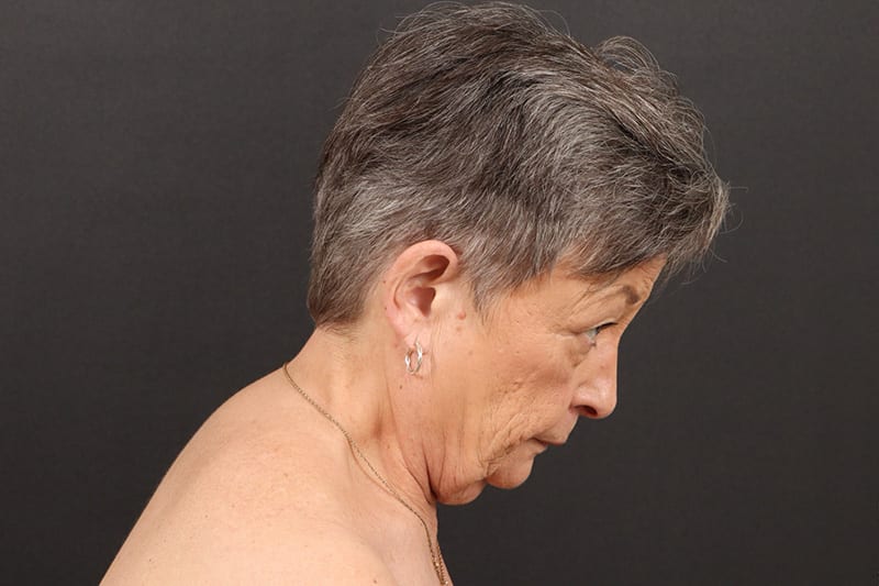 Face and Neck Lift Before & After Image