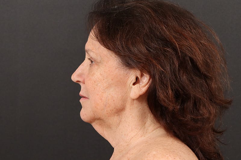 Face and Neck Lift Before & After Image