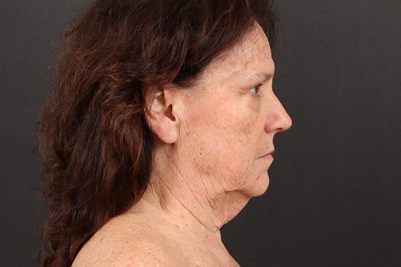 Face and Neck Lift Before & After Image