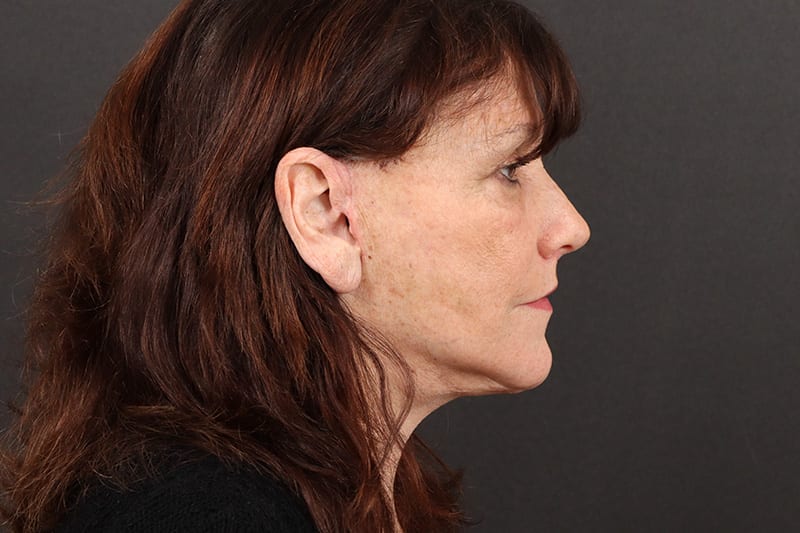 Face and Neck Lift Before & After Image