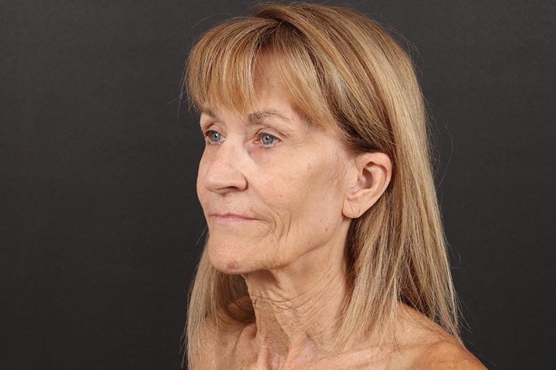 Face and Neck Lift Before & After Image