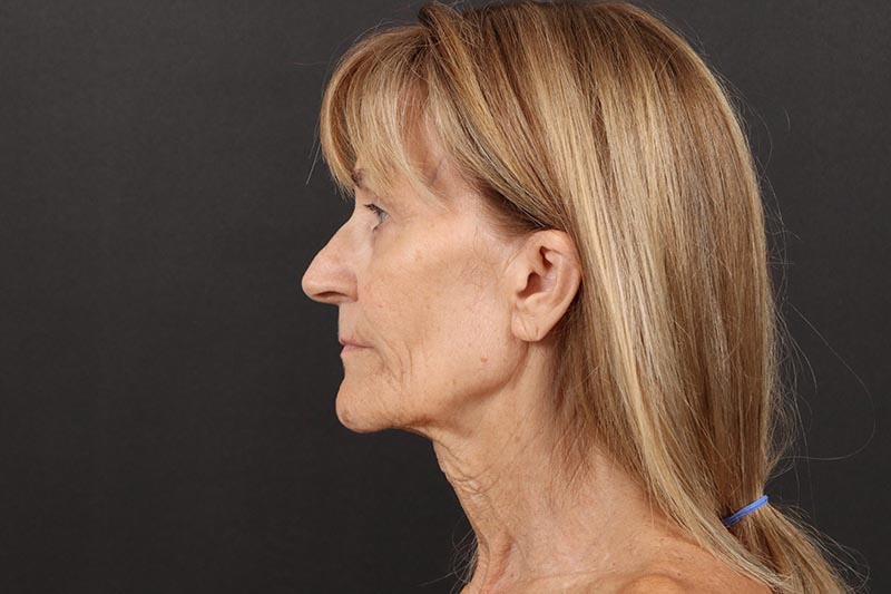 Face and Neck Lift Before & After Image