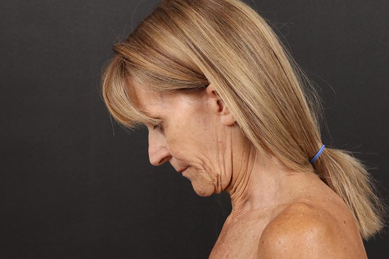 Face and Neck Lift Before & After Image