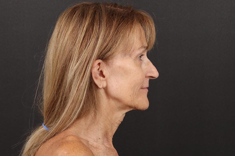 Face and Neck Lift Before & After Image