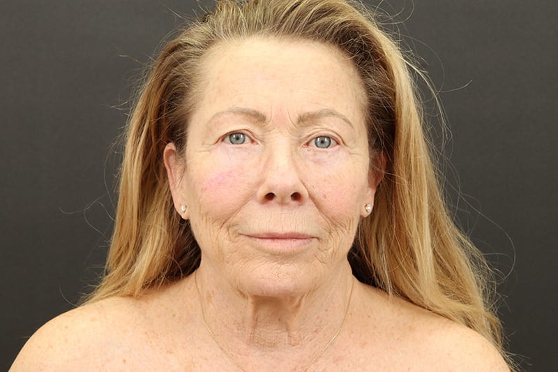 Face and Neck Lift Before & After Image