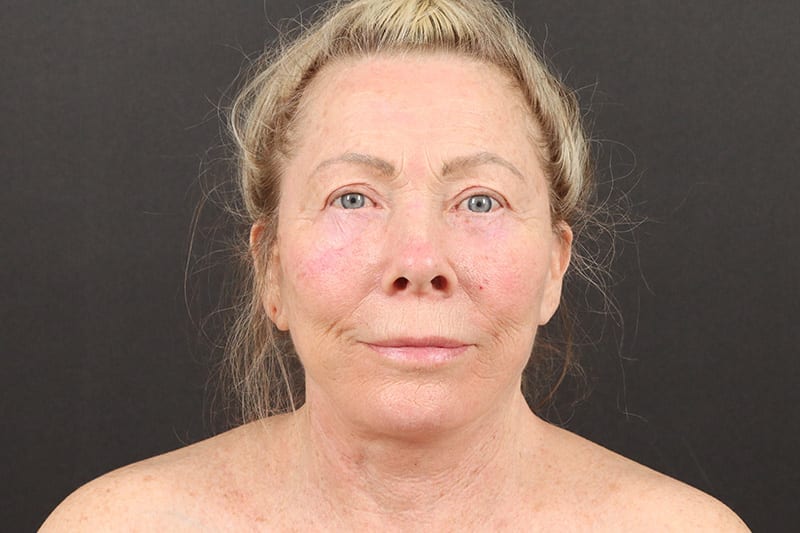 Face and Neck Lift Before & After Image