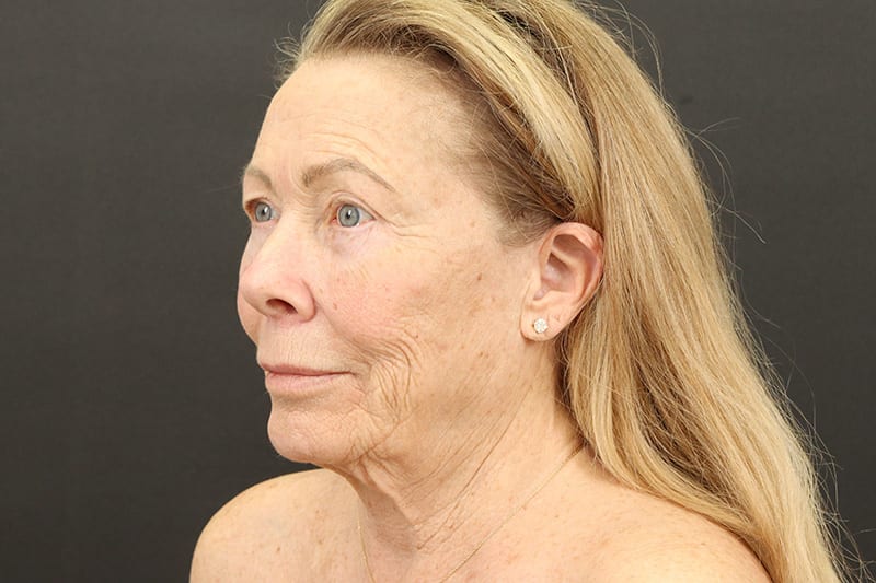 Face and Neck Lift Before & After Image