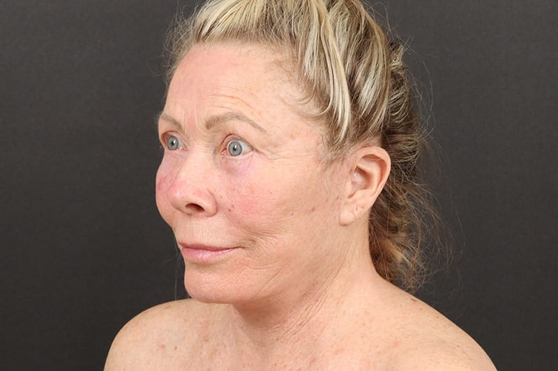 Face and Neck Lift Before & After Image