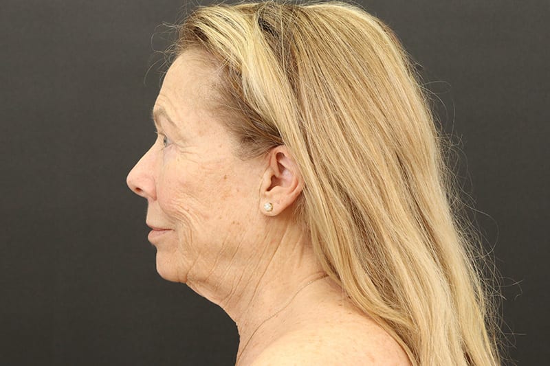 Face and Neck Lift Before & After Image