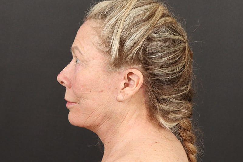 Face and Neck Lift Before & After Image