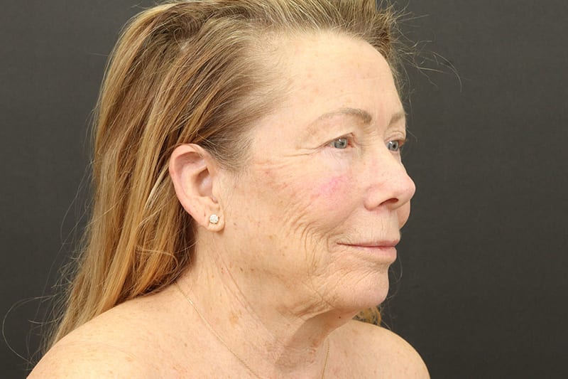 Face and Neck Lift Before & After Image