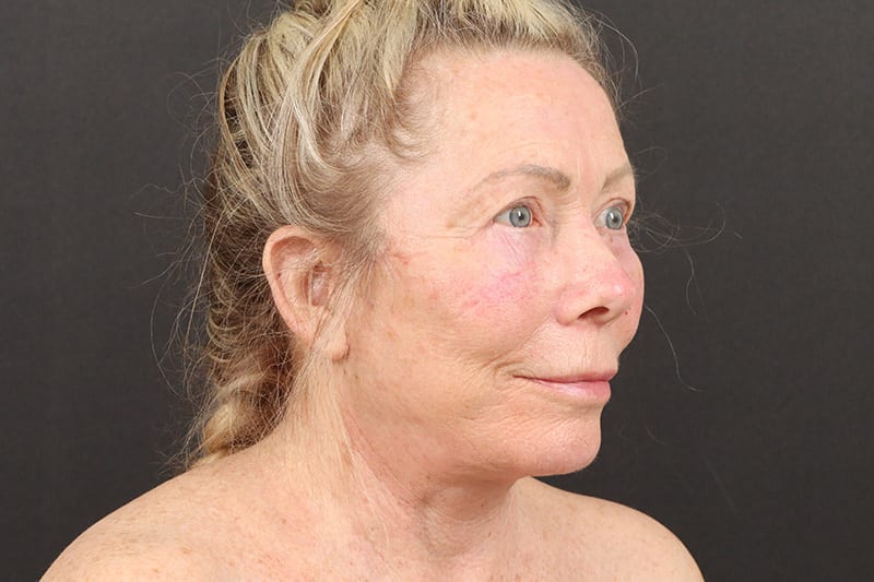 Face and Neck Lift Before & After Image