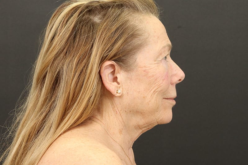 Face and Neck Lift Before & After Image