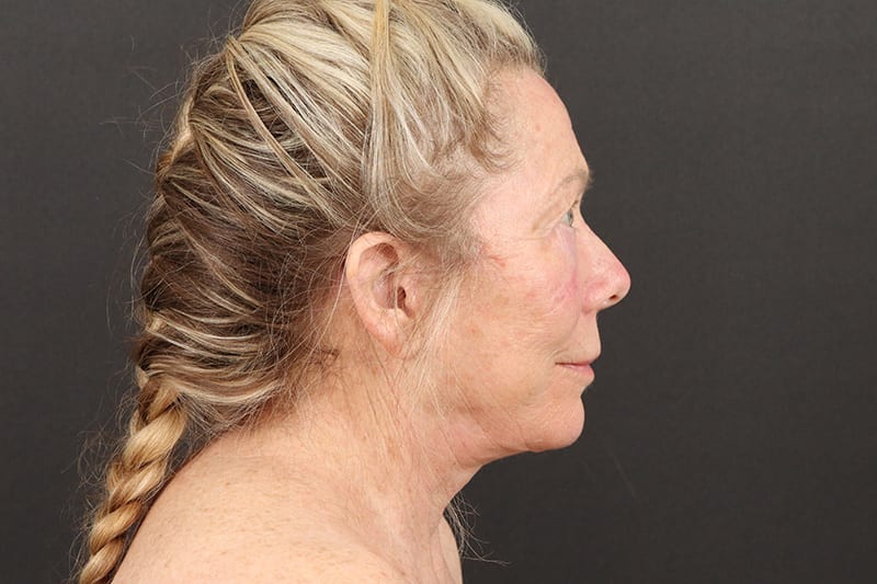 Face and Neck Lift Before & After Image