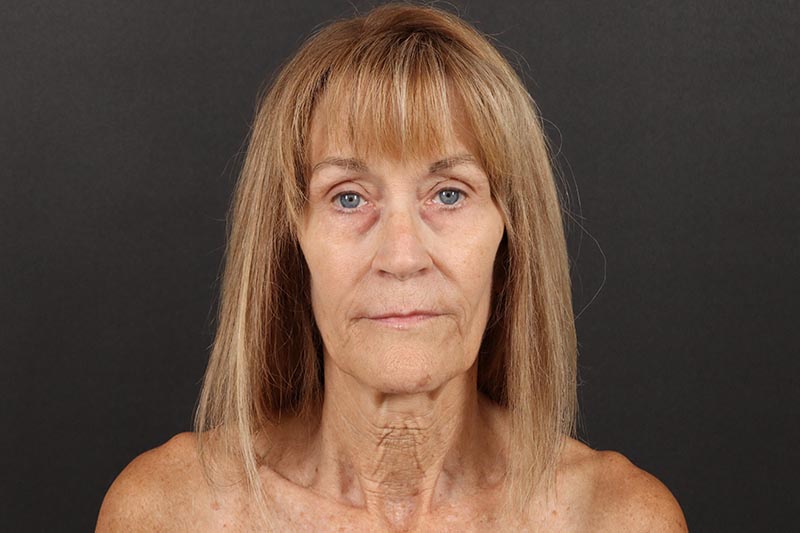 Face and Neck Lift Before & After Image