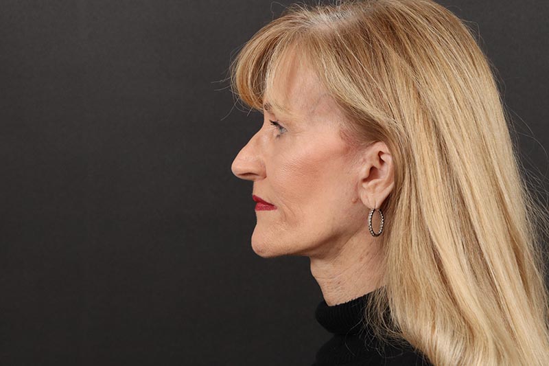 Face and Neck Lift Before & After Image