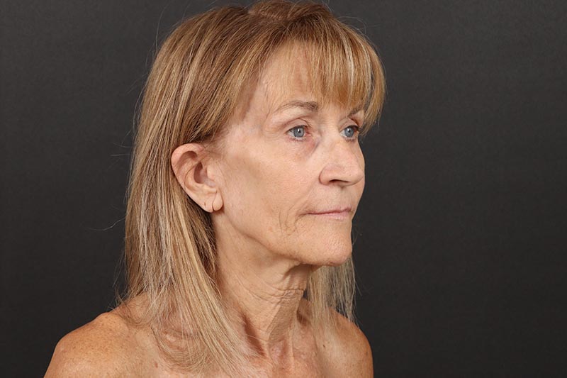 Face and Neck Lift Before & After Image