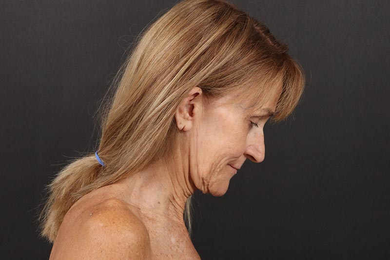 Face and Neck Lift Before & After Image