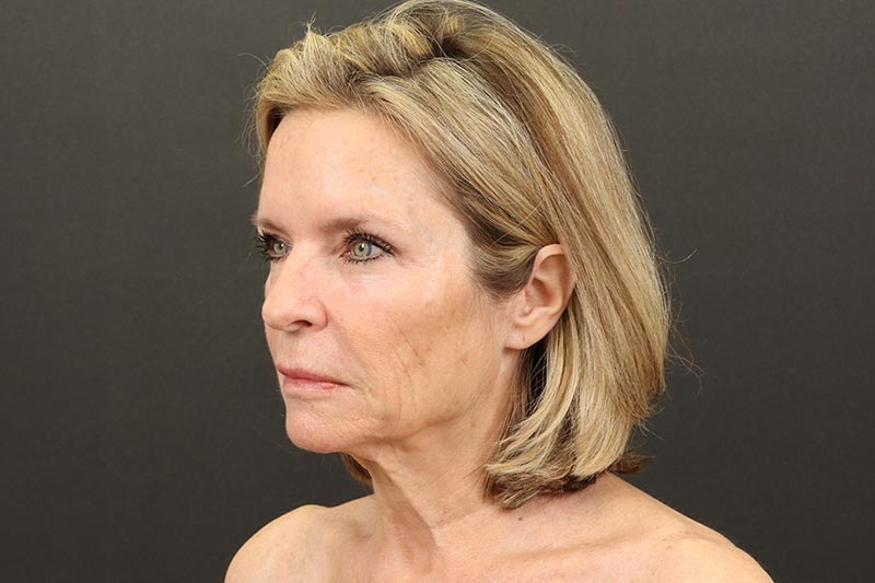 Face and Neck Lift Before & After Image