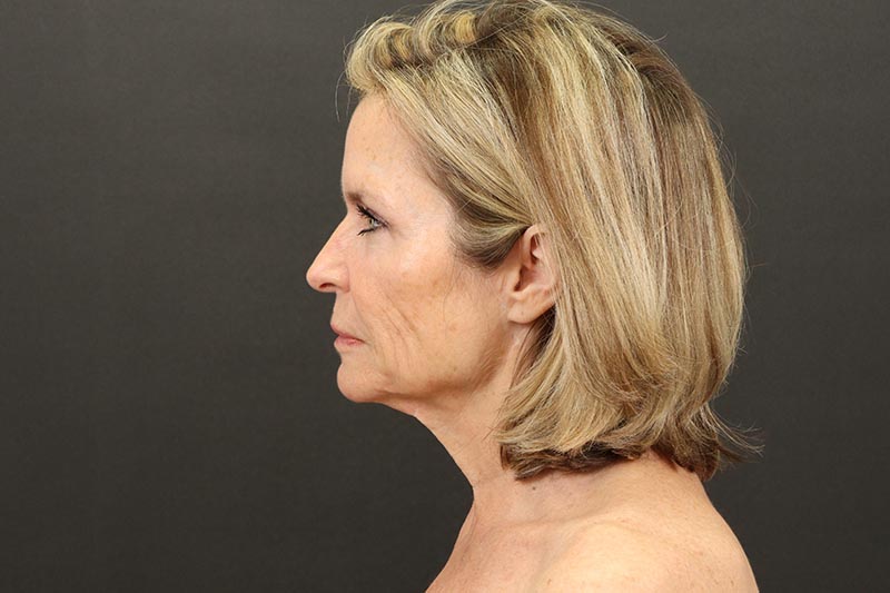 Face and Neck Lift Before & After Image