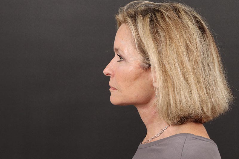 Face and Neck Lift Before & After Image