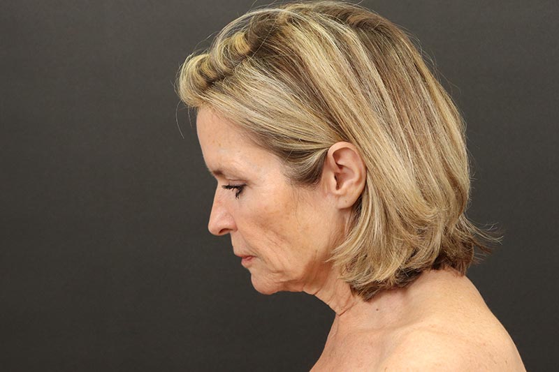 Face and Neck Lift Before & After Image