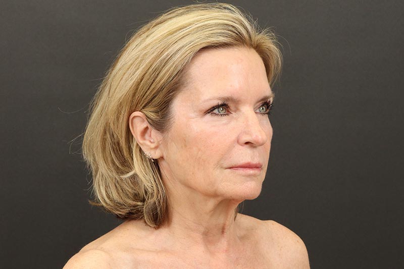 Face and Neck Lift Before & After Image