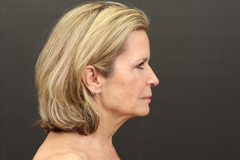 Face and Neck Lift Before & After Image