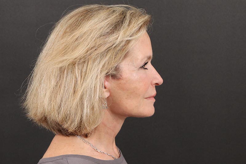 Face and Neck Lift Before & After Image