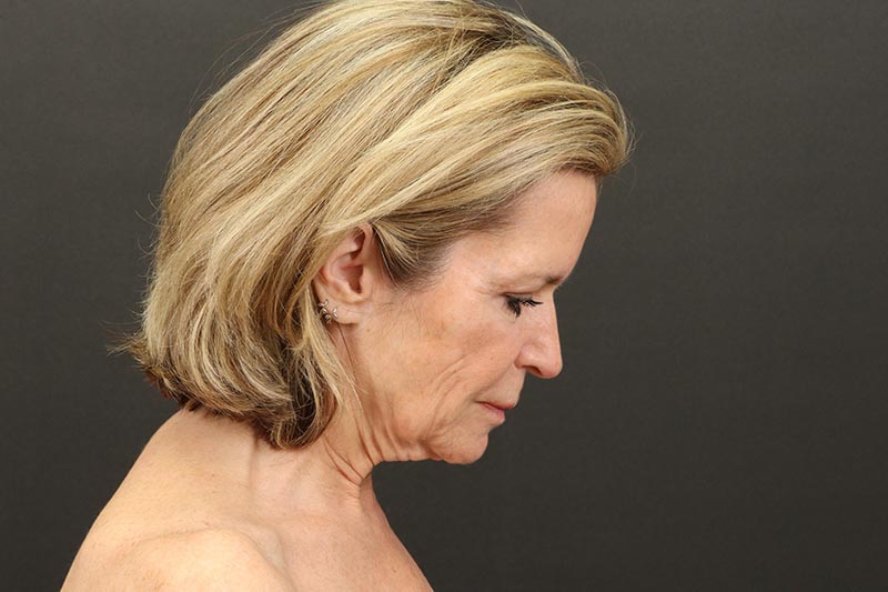 Face and Neck Lift Before & After Image