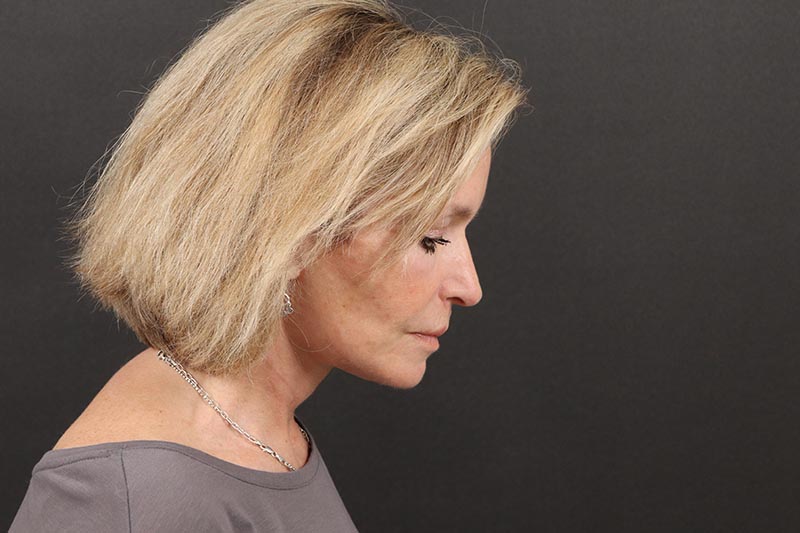 Face and Neck Lift Before & After Image