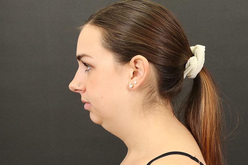 Neck Lift Before & After Image