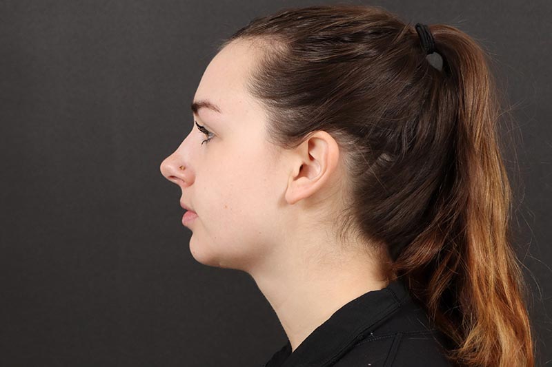 Neck Lift Before & After Image