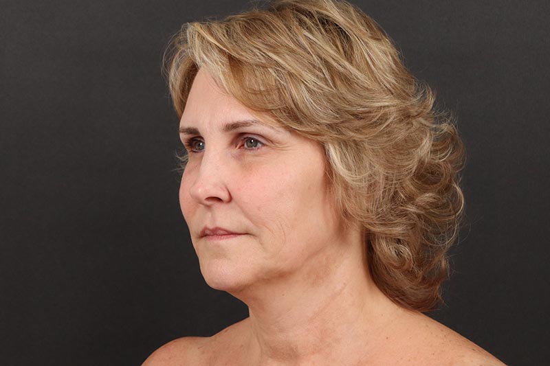 Neck Lift Before & After Image