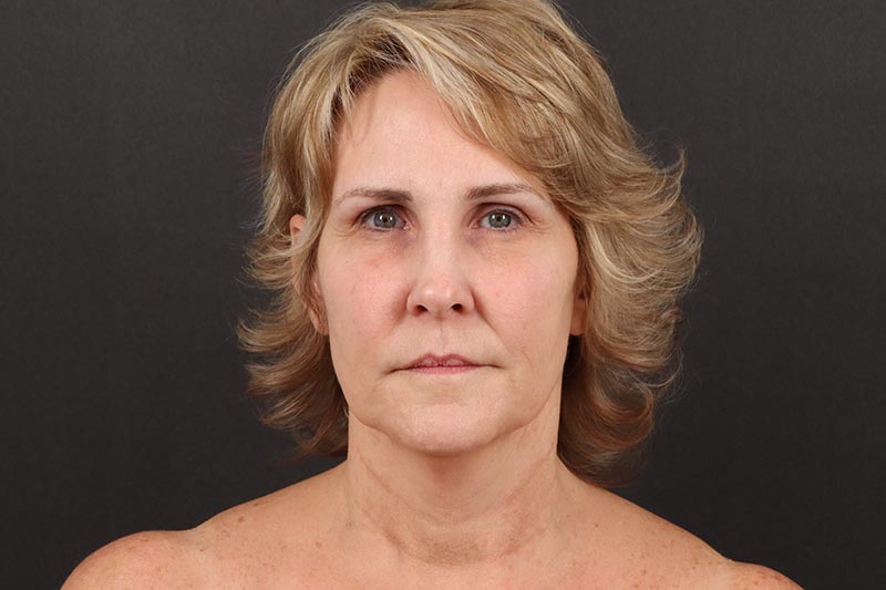 Neck Lift Before & After Image