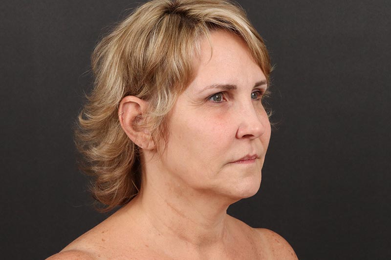 Neck Lift Before & After Image