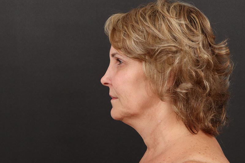 Neck Lift Before & After Image