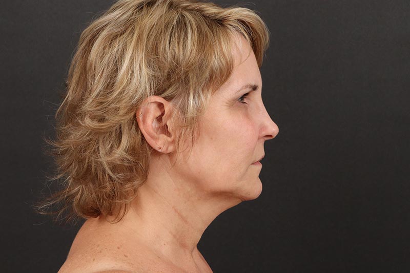 Neck Lift Before & After Image