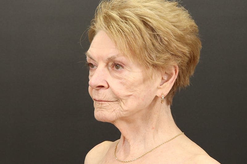 Neck Lift Before & After Image