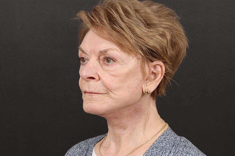 Neck Lift Before & After Image