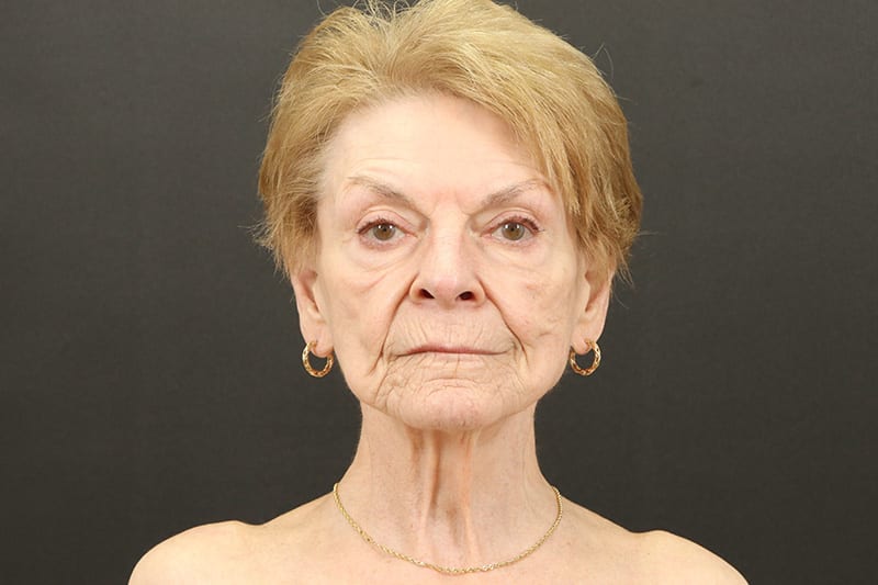 Neck Lift Before & After Image