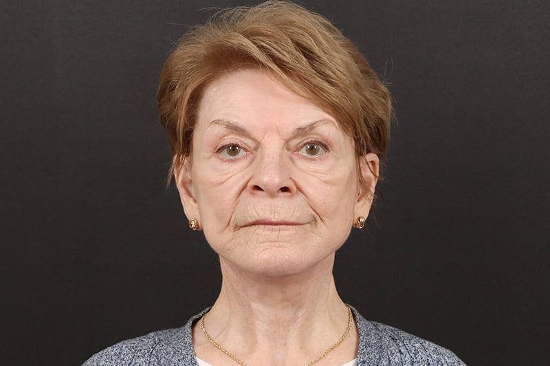 Neck Lift Before & After Image