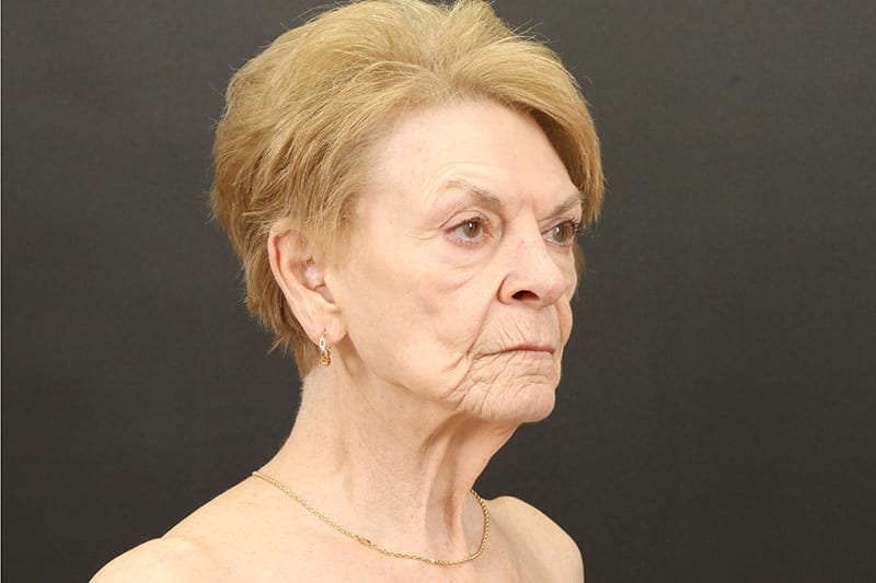 Neck Lift Before & After Image